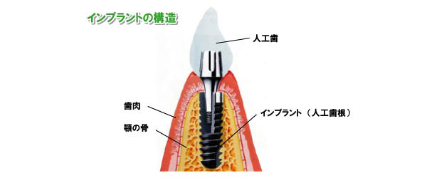 インプラントの構造