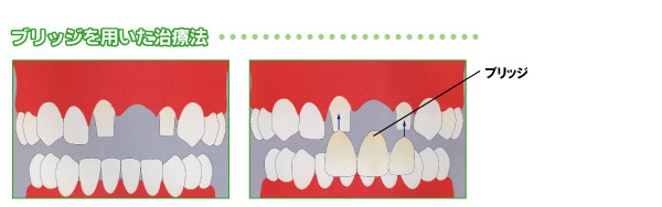 ブリッジを用いた治療法