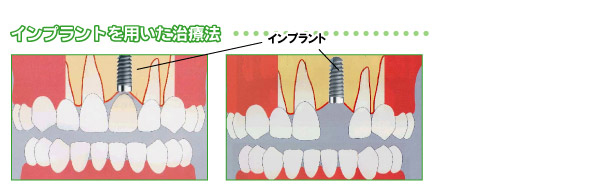 インプラントを用いた治療法