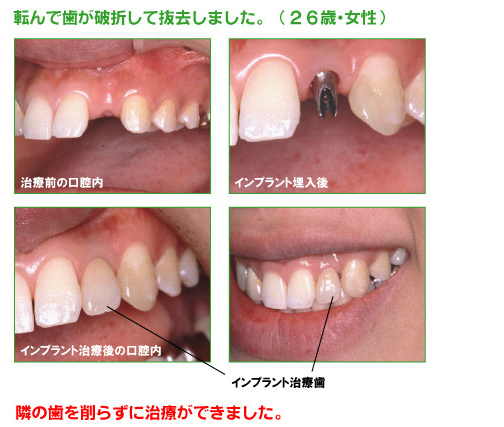 インプラント治療例　上顎前歯部
