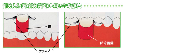 部分入れ歯を用いた治療法