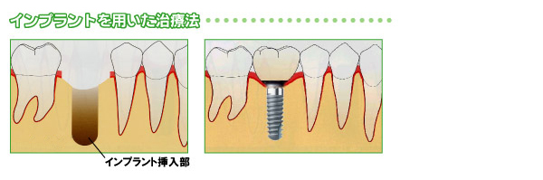 インプラントを用いた治療法