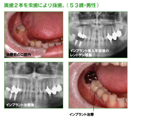 インプラント治療例