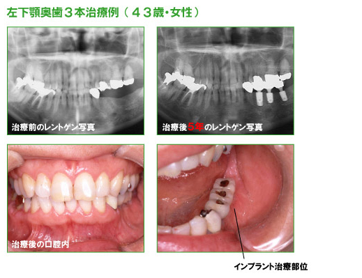 インプラント治療例