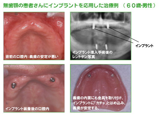 インプラント治療例