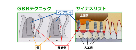 GBRテクニック　サイナスリフト